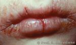 Atopinis dermatitas ( lūpų egzema )